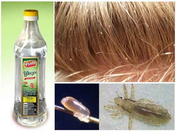 Как вывести вшей и гннид у ребенка или взрослого