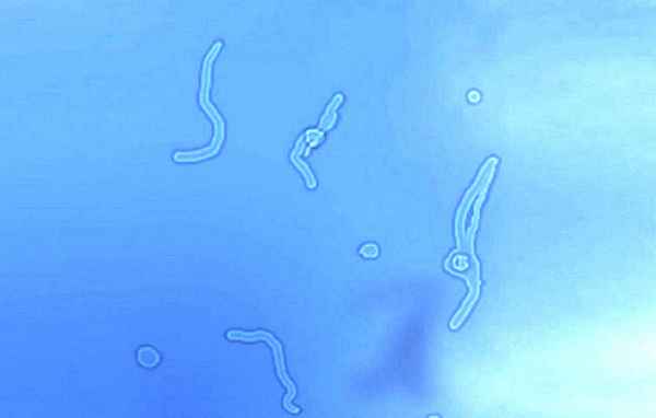 Мушки перед глазами что это: причины и лечение