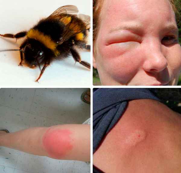 Укус шмеля, его последствия и первая помощь при укусе (фото)