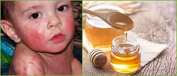 Аллергия на мед - симптомы, фото, лечение