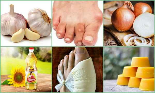 Особенности употрeбления лука и чеснока при подагре