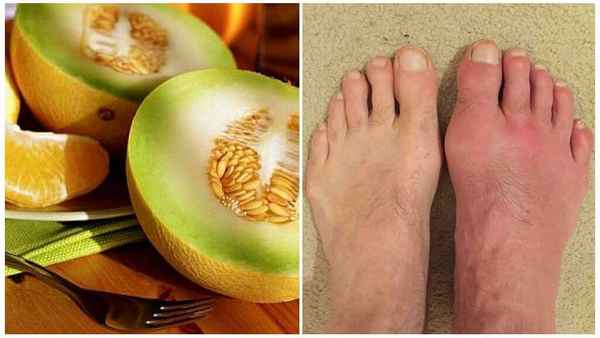 Особенности употрeбления дыни при подагре