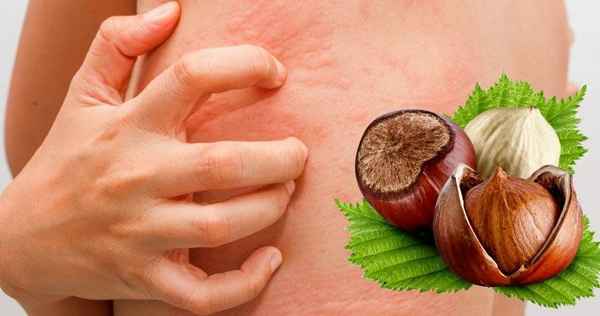 Лечение и профилактика аллергии на фундук