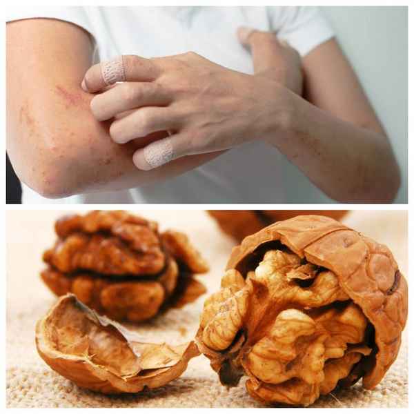 Аллергия на грецкие орехи