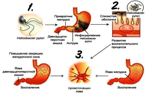 Особенности употрeбления яблок при язве желудка